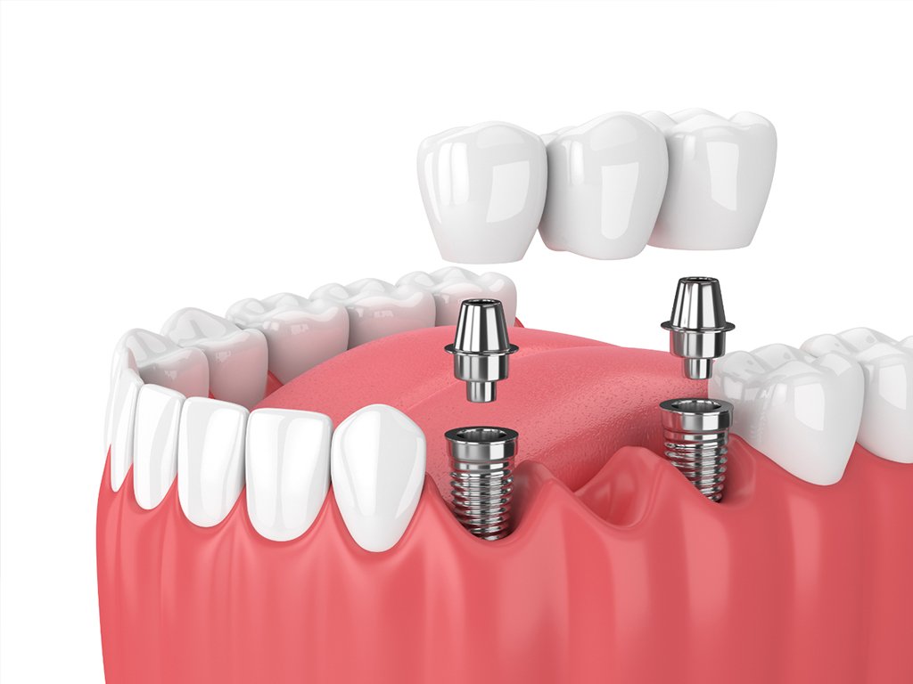 Dental Implants
