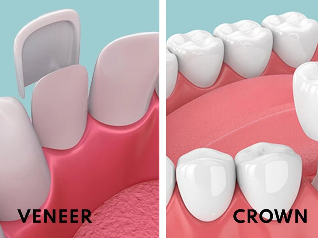 Veneers & Crowns